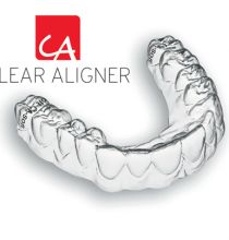 Niềng răng xong có bị hở lợi không?