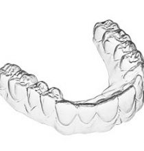 Kiến thức niềng răng
