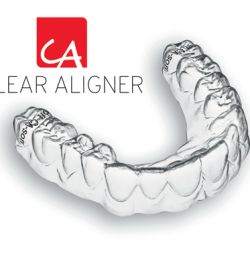 Quy trình niềng răng khớp cắn sâu